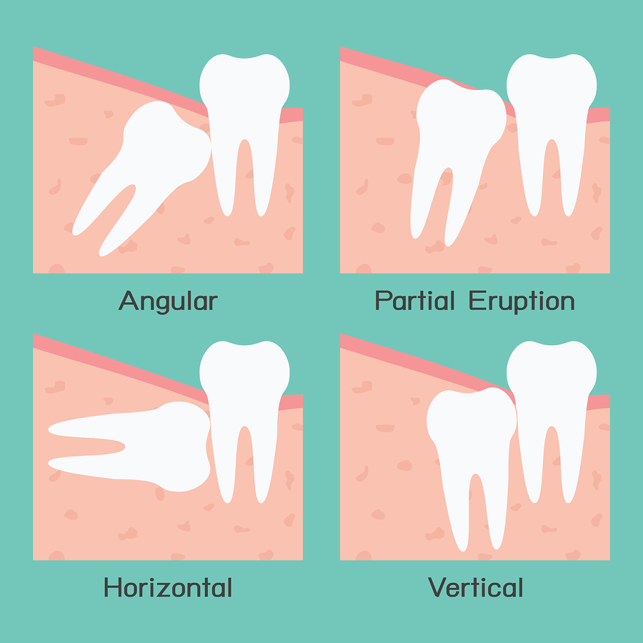 Wisdom Tooth