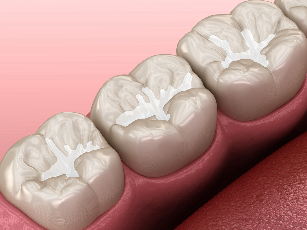 What are Dental Sealants?